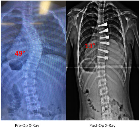 Through Anterior Scoliosis Correction, Dr. Lonner was able to correct Mya’s 49° thoracic curve to 13°. 