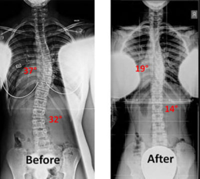 3 Prayers for Scoliosis – Hope for My Scoliosis