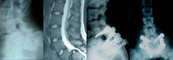 isthmic-case1