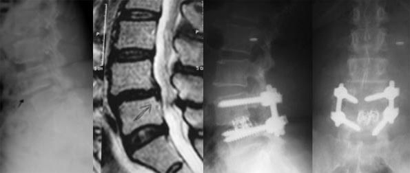 isthmic-case2