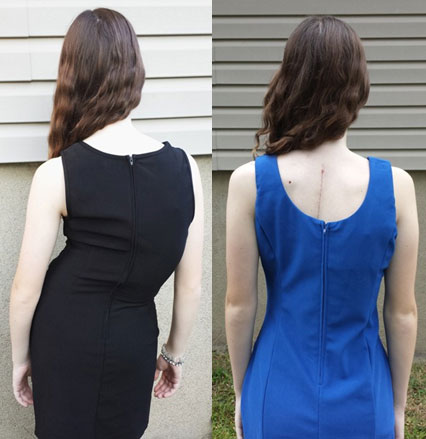 Image result for scoliosis before after