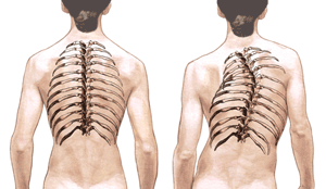 scoliosis_illus100