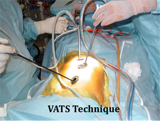 vats-technique