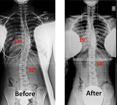 xray-spinal1