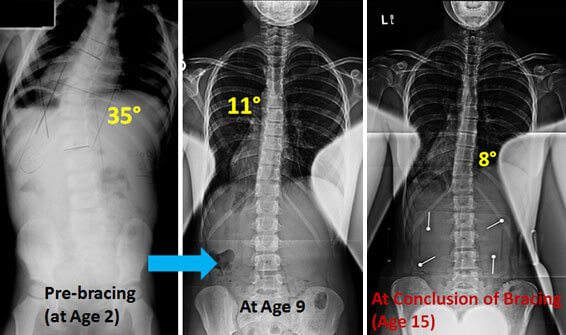 My Scoliosis Story — From a Pillow Inventor, by enVy Pillow