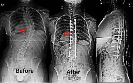 xray-spinal3