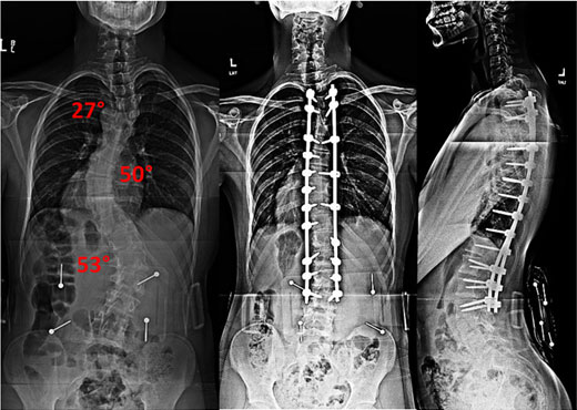 xray-triple-curve