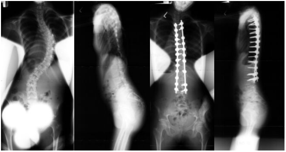 Adolescent Neuromuscular Disease Case 1