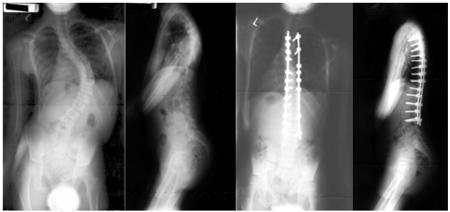 Adolescent Neuromuscular Disease Case 2