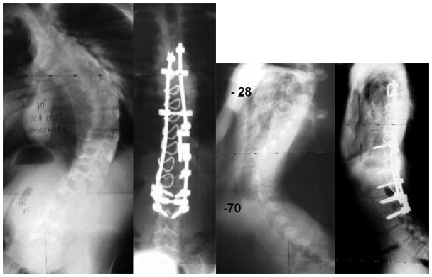 Adolescent Neuromuscular Disease Case 3