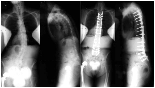 Adult Neuromuscular Disease Case 1