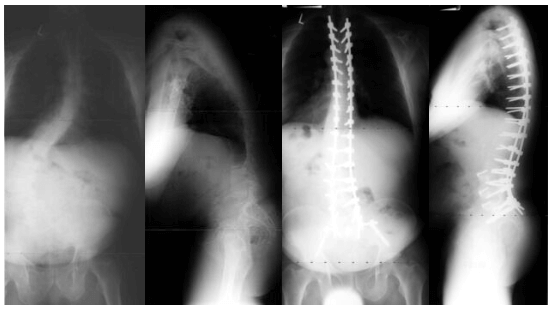 Adult Neuromuscular Disease Case 2