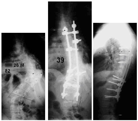 Adult Scoliosis Case Example 1