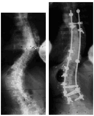 Adult Scoliosis Case Example 2