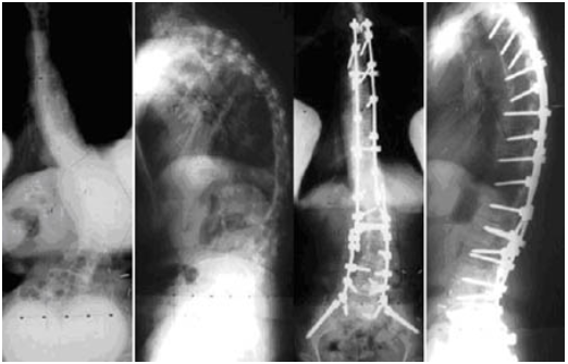 Adult Scoliosis Case Example 3