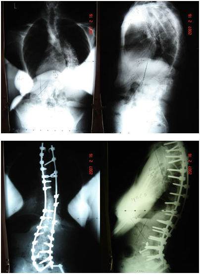 Adult Scoliosis Case Example 4