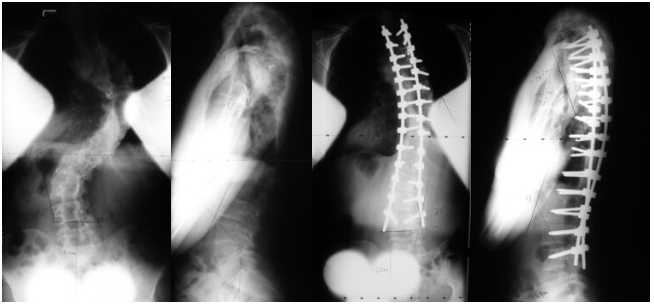 Adult Scoliosis Case Example 5