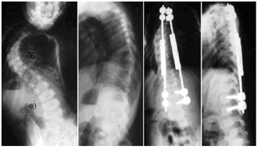 Early Onset Scoliosis