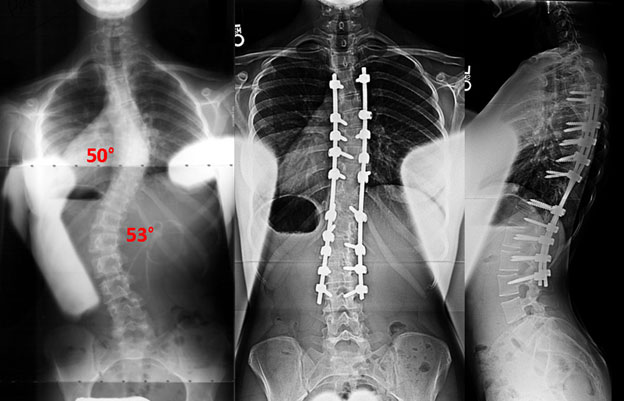 Ehlers-Danlos Syndrome