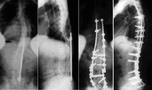 Flatback Syndrome Case 1