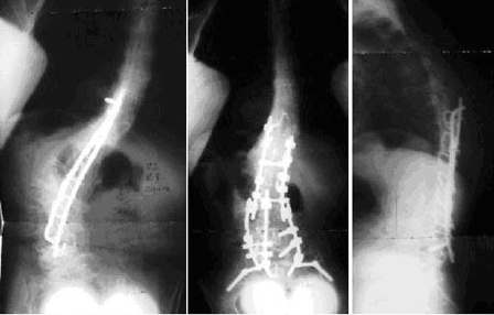 Flatback Syndrome Case 2