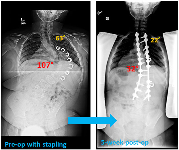 Prader-Willi syndrome