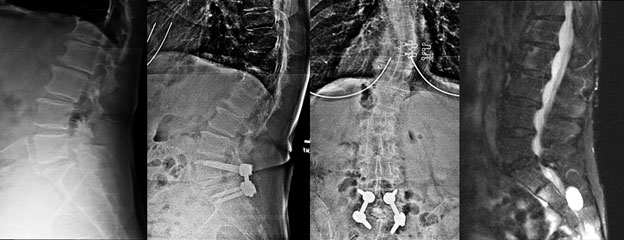 Spinal Stenosis xray