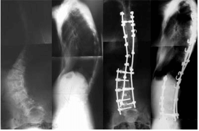 Unusual Causes of Scoliosis Case 1