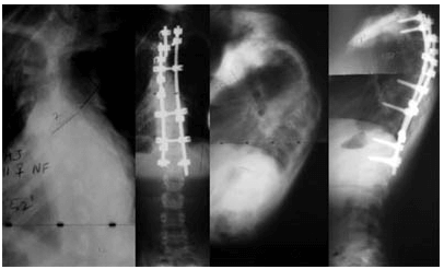 Unusual Causes of Scoliosis Case 2