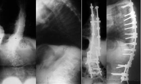 Unusual-Causes-of-Scoliosis-Case-3