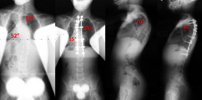 neurofibromatosis