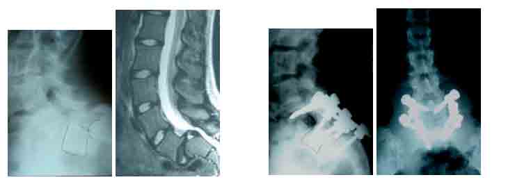 Isthmic Spondylolisthesis Case