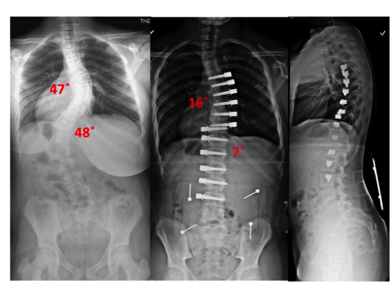 Nonfusion Corrective Scoliosis Surgery Scoliosis and Spine Associates