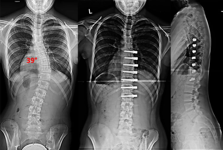 Nonfusion Corrective Scoliosis Surgery Scoliosis and Spine Associates