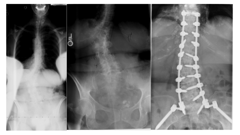 degenerative scoliosis