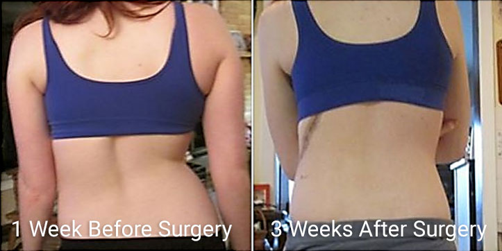 shelby-before-after Scoliosis Surgery Before & After