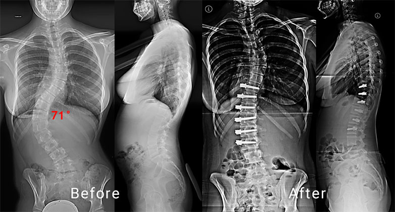 VBT Scoliosis Surgery XRAY