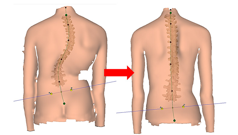 Pre & Post Op ScoliScan