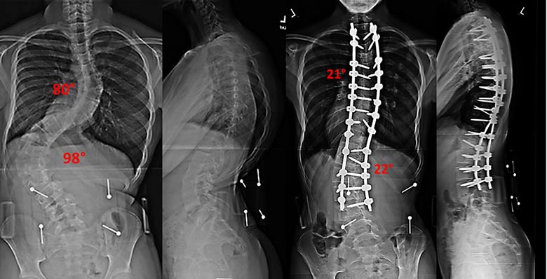 X-rays before and after surgery