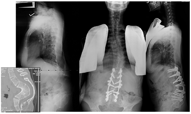 Congenital Scoliosis and Kyphosis