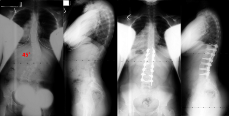 Neurofibromatosis