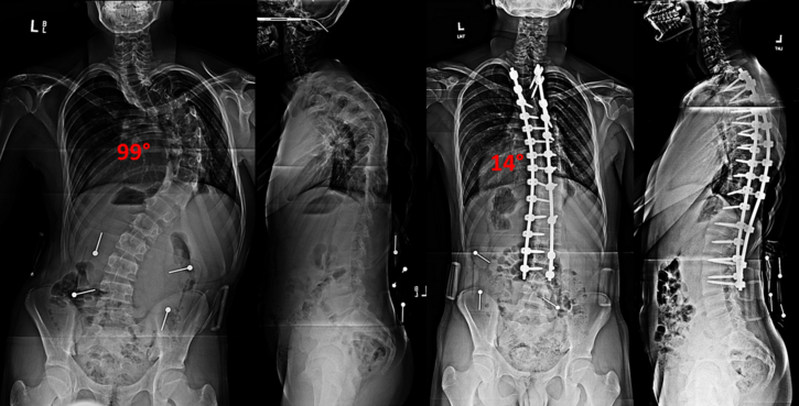 Spinal Fusion with Instrumentation
