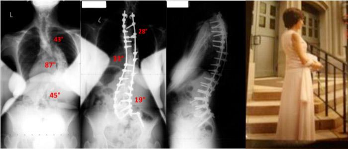 adult-spinal-correction