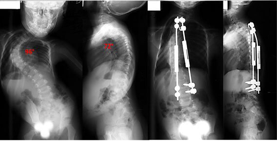 early-onset-scoliosis-story1-photo