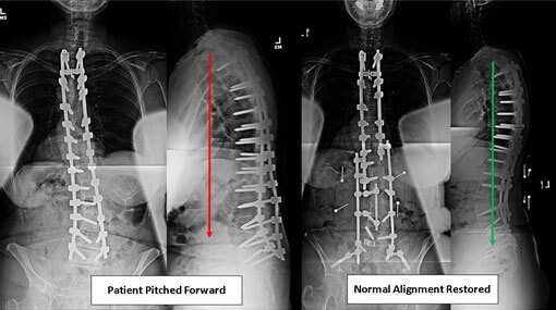 flatback-syndrome-story1 flatback-syndrome-story1