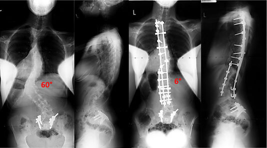 marfan-syndrome-story1-photo marfan-syndrome-story1-photo