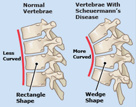 Scheuermann's Kyphosis - Scoliosis and Spine Associates