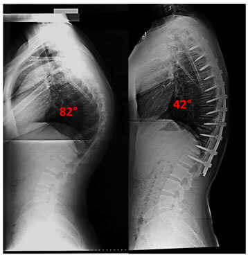 scheuremanns-kyphoiss-story-xray
