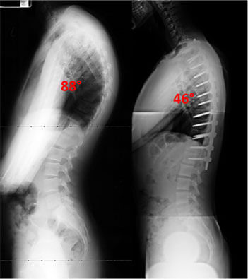 scheuremanns-kyphoiss-story2-xray