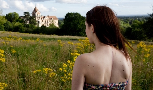 young girl with scoliosis standing at the meadow and looking at the distance